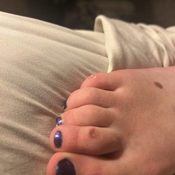 Designer Nails - 2 weeks after toe burn - Nail Salons Near Me - Keizer, Oregon