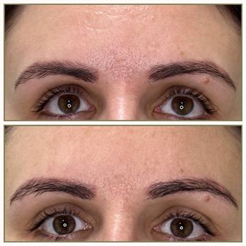 Pretty face - Before/ After Result after 1 session - Estheticians Near Me - San Diego, California Pretty face - Before/ After Result after 1 session - Estheticians Near Me - San Diego, California