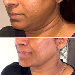 Defined Jawline and Double Chin reduction. Defined Jawline and Double Chin reduction.