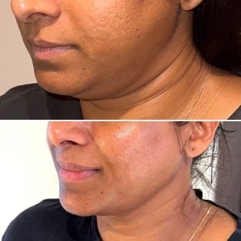 Illumin Wellness - Defined Jawline and Double Chin reduction. - Cryotherapy Near Me - Danville, California Illumin Wellness - Defined Jawline and Double Chin reduction. - Cryotherapy Near Me - Danville, California