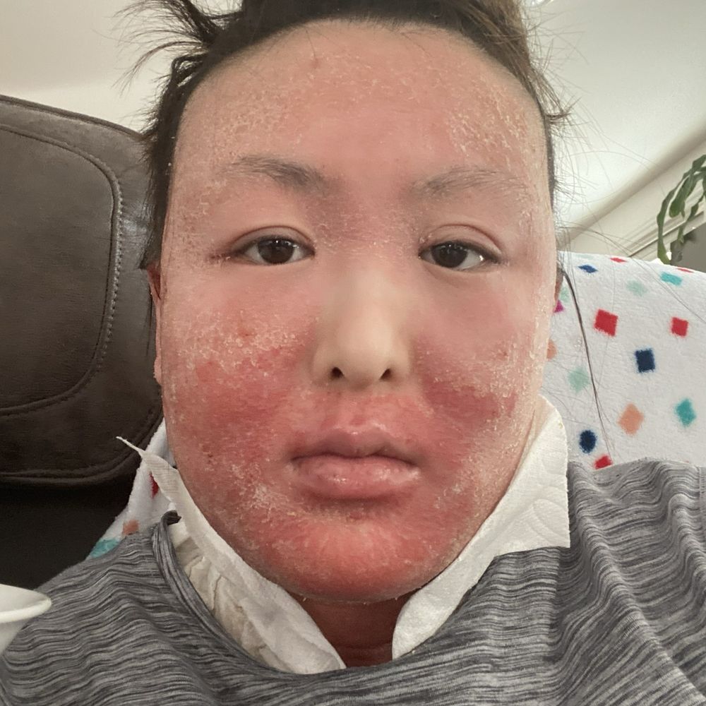 Create Wellness - raw, oozing/peeling skin - Acupuncture Near Me - San Diego, California