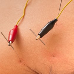 New Orleans Acupuncture
