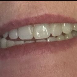 Indiana Oral and Maxillofacial Surgery Associates - That's the best smile I could give my mouth is humming with pain.