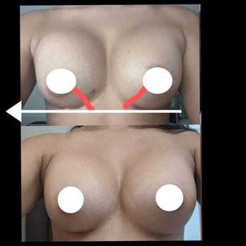 Smith Plastic Surgery - Uneven incisions - Cosmetic Surgeons Near Me - Las Vegas, Nevada
