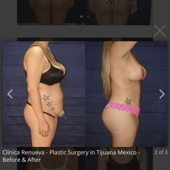 Clínica Renueva - Tummy tuck + BBL - Cosmetic Surgeons Near Me - Tijuana, BCN Clínica Renueva - Tummy tuck + BBL - Cosmetic Surgeons Near Me - Tijuana, BCN
