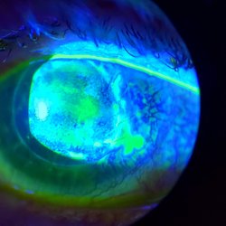 Karlin J David MD - Herpes Simplex of the Cornea