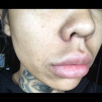 Devine Image - Filler above the lip line. Causing a protrusion in my philtrum ridges - Medical Spas Near Me - Tustin, California