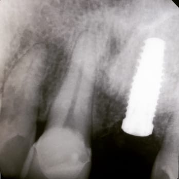 Chad M Cravatta, DMD - My implant is just about ready for a crown. - Periodontists Near Me - Mesa, Arizona Chad M Cravatta, DMD - My implant is just about ready for a crown. - Periodontists Near Me - Mesa, Arizona