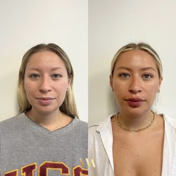 Full facial balance - 2nd session