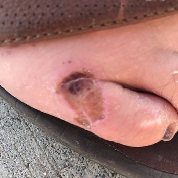 Nina's Nails & Alterations - His right foot burn healing up two days after the occurrence. - Sewing & Alterations Near Me - Hilo, Hawaii Nina's Nails & Alterations - His right foot burn healing up two days after the occurrence. - Sewing & Alterations Near Me - Hilo, Hawaii