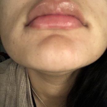 Flawless MedSpa - 5 days after filler - Medical Spas Near Me - Burlington, Massachusetts Flawless MedSpa - 5 days after filler - Medical Spas Near Me - Burlington, Massachusetts