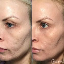 Arcadia Wellness Center - Acne scarring treatment