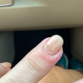 Venus Nail & Spa - finger infection.. thanks for that! - Nail Salons Near Me - Napa, California Venus Nail & Spa - finger infection.. thanks for that! - Nail Salons Near Me - Napa, California