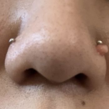Pierced. - Horrible irritation bump caused by cheap metal from another location in Fullerton. - Piercing Near Me - Orange, California