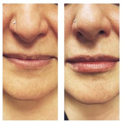 Facecard Medspa - 1 ML OF JUVADERM UC, LIP FILLER (NATURAL LOOK)