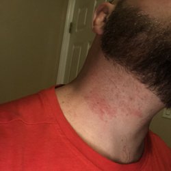 Carmelo's Barber Shop - This is my neck within the hour of the shave.