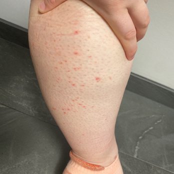 The Peach Bar - Back of calf, many inflamed ingrowns shown. - Waxing Near Me - Clifton, New Jersey The Peach Bar - Back of calf, many inflamed ingrowns shown. - Waxing Near Me - Clifton, New Jersey