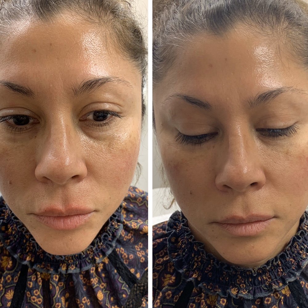 Mirror Mirror Aesthetics & Wellness - Tear trough filler - Medical Spas Near Me - Tucson, Arizona