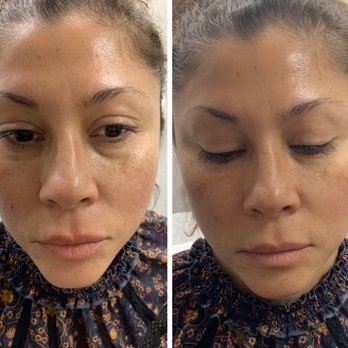 Mirror Mirror Aesthetics & Wellness - Tear trough filler - Medical Spas Near Me - Tucson, Arizona Mirror Mirror Aesthetics & Wellness - Tear trough filler - Medical Spas Near Me - Tucson, Arizona