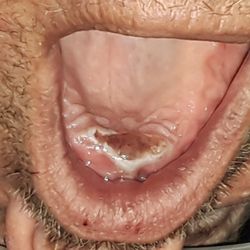 Hart Family Dental - 3rd degree burns. Patient (my client) was told there was no problem and told to go home. Outcome of case is pending.