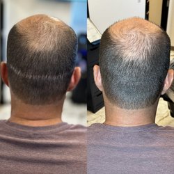 DK SMP - FUT scar cover up