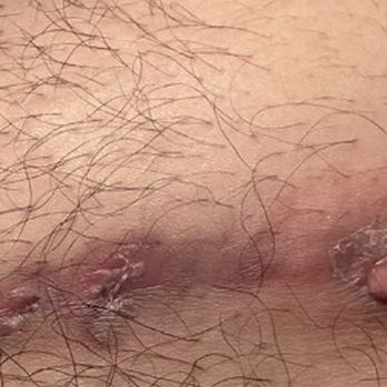 Sono Bello Ontario - Clearly an infection, draining since November 2025, no medication was offered of any kind. - Cosmetic Surgeons Near Me - Ontario, California