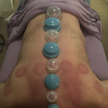 Megans Methods - Cupping Therapy is a wonderful treatment using reverse pressure to release facial layers, tension and toxins from soft tissues - Reiki Near Me Megans Methods - Cupping Therapy is a wonderful treatment using reverse pressure to release facial layers, tension and toxins from soft tissues - Reiki Near Me