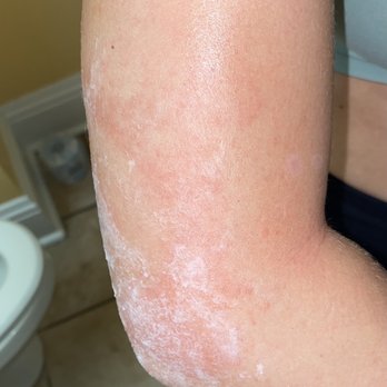 Iron Tiger Tattoo - Tattoo infection. - Piercing Near Me - Columbia, Missouri Iron Tiger Tattoo - Tattoo infection. - Piercing Near Me - Columbia, Missouri