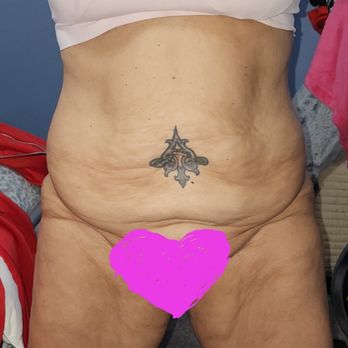Gerut Zachary E - Fold after fold before tummy tuck - Cosmetic Surgeons Near Me - Hewlett, New York