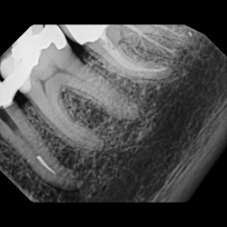 Wesley Dental - File broke into tooth