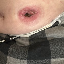 Garden Terrace of Houston - Skin irritation around stoma due to uneducated nursing staff