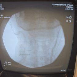 HI Pain - Hawaii Institute for Pain - 3 long needles all at the same time deep into my neck while I was balancing on my nose face down on the table-SCREAMING-no empathy at all