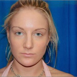 C/V ENT Surgical Group - Encino - RHINOPLASTY PATIENT BEFORE
