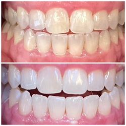 Deebeaut - Teeth Whitening