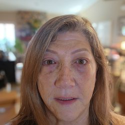 Ben J Childers, MD - I have eyelids but still some bruising.