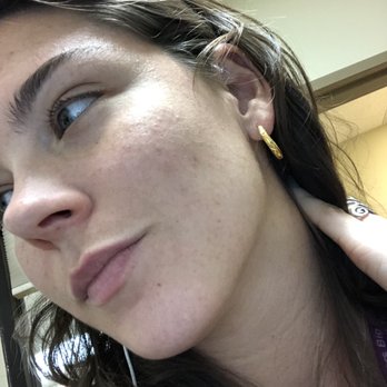 Atlanta Acne Specialists - After - Skin Care Near Me - Decatur, Georgia