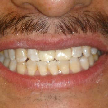 EZ Dental Care - Implant (after) - General Dentistry Near Me - Flushing, New York EZ Dental Care - Implant (after) - General Dentistry Near Me - Flushing, New York