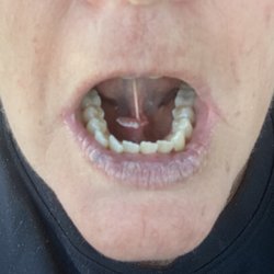 San Diego Surgical Arts - Photo of blockage. The white part is infection.