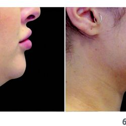 Fat-Freeze Body-Sculpting - Before & after coolsculpting type of procedure (cryolipolysis) under chin plus RF skin tightening 2 sessions