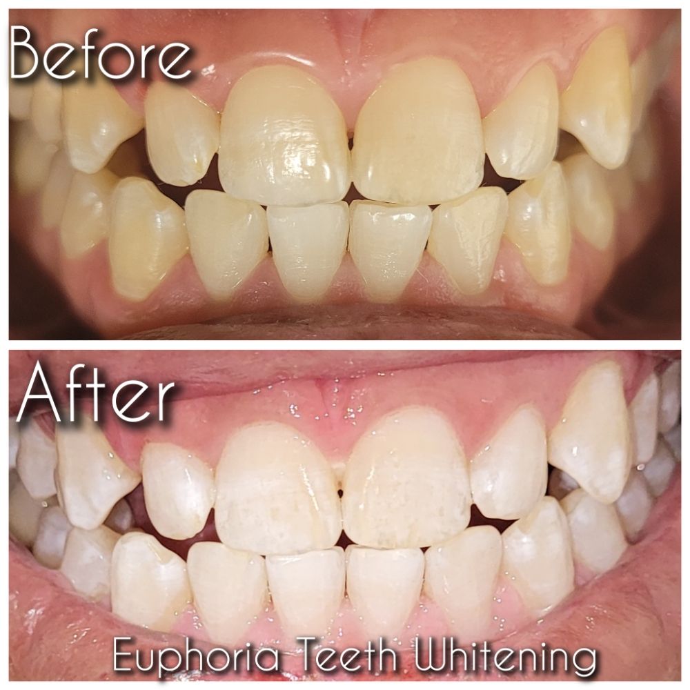 EUPHORIA TEETH WHITENING AND GEMS Updated June 2024 Request an