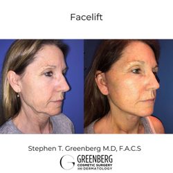 Stephen T. Greenberg, MD - Facelift Before and After
