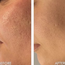 Pretty Like you Aesthetics - Skin Pen Microneedling