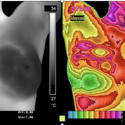 Radiant Body Thermography - Confirmed malignancy; visible heat from the extra blood vessels feeding 3 tumors in patient's right breast.