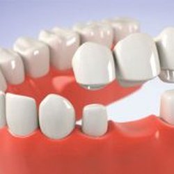My Family Dental Novi - Come for a FREE consultation to learn about dental implants, a permanent solution to missing teeth!