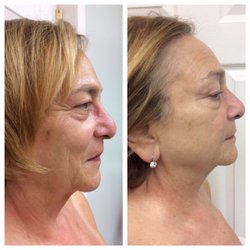 Rive Nail Skin Care Spa - After 8 Treatments of Microcurrent.