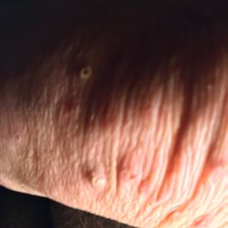 Pelican Family Medicine At Monkey - Photo of knee with thickened skin and very old typical scabies bumps