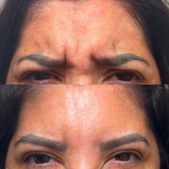Oresmie Aesthetics - Dysport treatment results! - Medical Spas Near Me - Payson, Arizona Oresmie Aesthetics - Dysport treatment results! - Medical Spas Near Me - Payson, Arizona