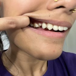 All Care Dental by the Sea - Messed up my teeth and bite