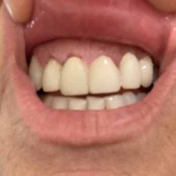 Serenity Dental Group - Laser Cut Gums made my smile worst than before - Cosmetic Dentists Near Me - San Jose, California Serenity Dental Group - Laser Cut Gums made my smile worst than before - Cosmetic Dentists Near Me - San Jose, California