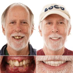 Louisiana Implants and Dentures - Complete smile restored with all-on-x dental implants.